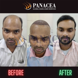 Hair Transplant Clinic Before and After Result in Delhi